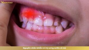 Nguyên nhân khiến trẻ bị sưng nướu có mủ