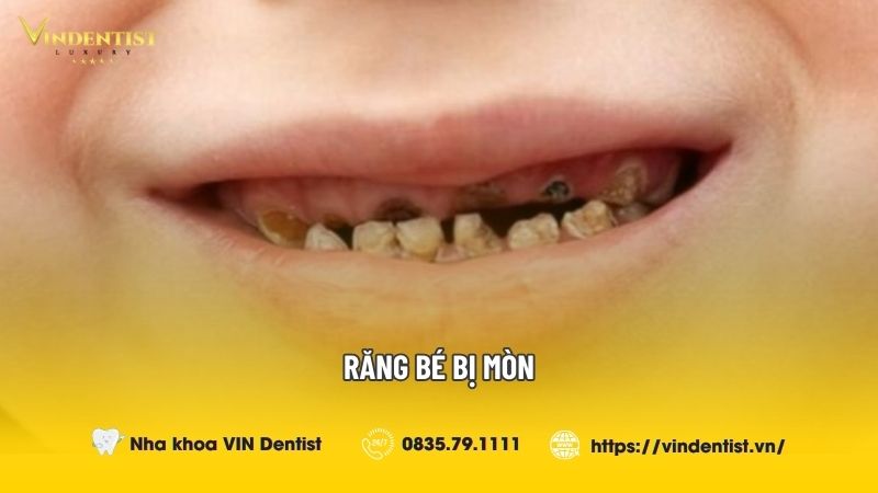 Răng Bé Bị Mòn Phải Làm Sao? Những Điều Bố Mẹ Cần Lưu Ý