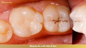 Răng bị sâu xuất hiện lỗ đen