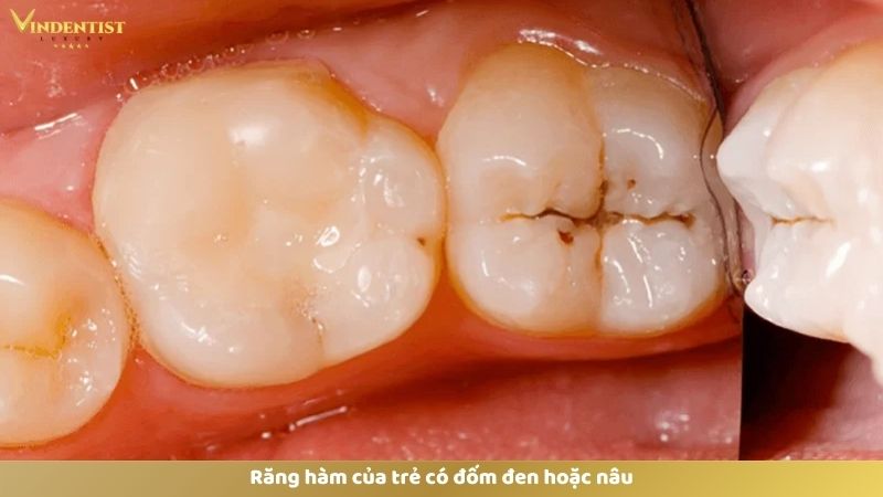 Trẻ Bị Sâu Răng Hàm: Bố Mẹ Cần Làm Gì Và Cách Phòng Tránh 19 Răng hàm của trẻ có đốm đen hoặc nâu