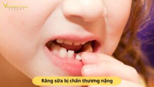 Răng sữa bị chấn thương nặng