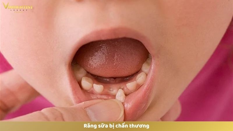 Bật Mí Cách Làm Trắng Răng Cho Bé 1 Tuổi An Toàn, Hiệu Quả 12 Răng sữa bị chấn thương