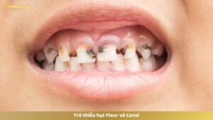 Thiếu hụt Canxi và Fluor