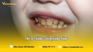 Trẻ 15 Tháng Tuổi Bị Vàng Răng: Cách Xử Lý Đơn Giản Tại Nhà
