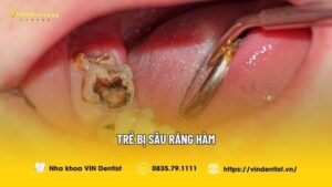 Trẻ Bị Sâu Răng Hàm: Bố Mẹ Cần Làm Gì Và Cách Phòng Tránh