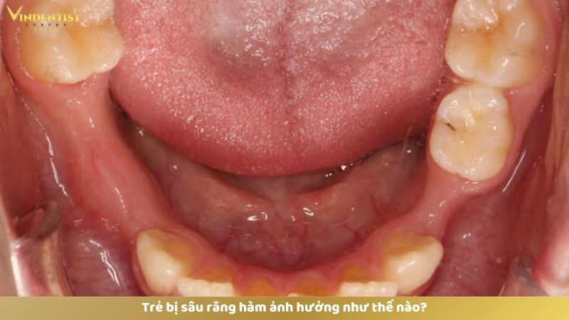 Trẻ Bị Sâu Răng Hàm: Bố Mẹ Cần Làm Gì Và Cách Phòng Tránh 21 Trẻ bị sâu răng hàm ảnh hưởng như thế nào?