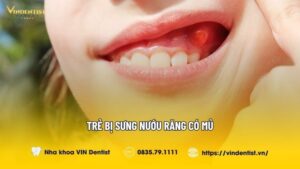 Trẻ Bị Sưng Nướu Răng Có Mủ Nguy Hiểm Không? | VIN Dentist