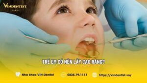 Trẻ Em Có Nên Lấy Cao Răng? Lợi Ích Và Lưu Ý Quan Trọng