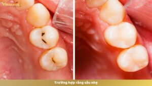 Trường hợp răng sâu nhẹ