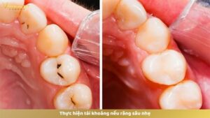 Trường hợp răng sâu nhẹ