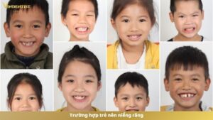 Trường hợp trẻ nên niềng răng