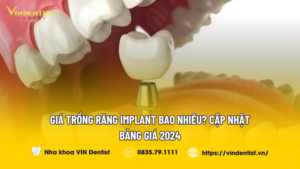Giá Trồng Răng Implant Bao Nhiêu