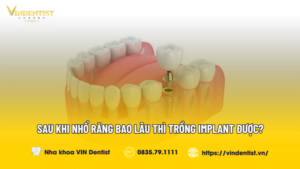 Sau Khi Nhổ Răng Bao Lâu Thì Trồng Implant Được