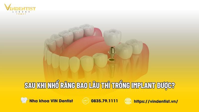 Sau Khi Nhổ Răng Bao Lâu Thì Trồng Implant Được