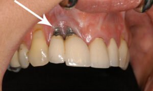 Tác Hại Của Việc Trồng Răng Implant Giá Rẻ gây tổn thương các vùng xung quanh