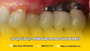 Tác Hại Của Việc Trồng Răng Implant Giá Rẻ Nên Biết