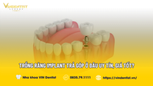 Trồng Răng Implant Trả Góp Ở Đâu Uy Tín, Giá Tốt