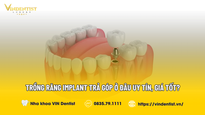 Trồng Răng Implant Trả Góp Ở Đâu Uy Tín, Giá Tốt