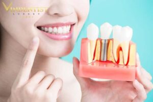 Trồng răng implant trả góp