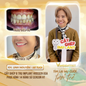 trồng răng implant giá bao nhiêu