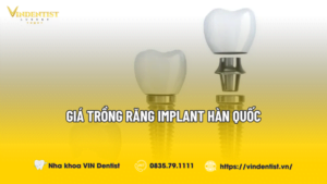 Giá Trồng Răng Implant Hàn Quốc Bao Nhiêu? Cập Nhật 2024