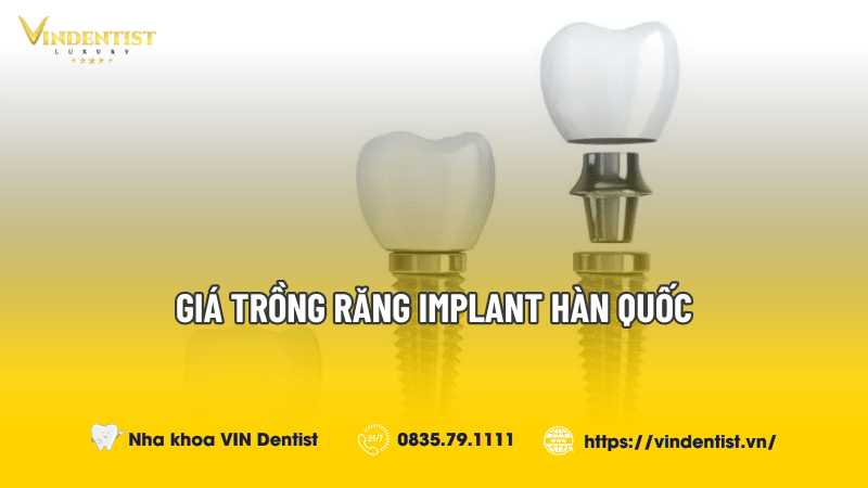 Giá Trồng Răng Implant Hàn Quốc Bao Nhiêu? Cập Nhật 2024