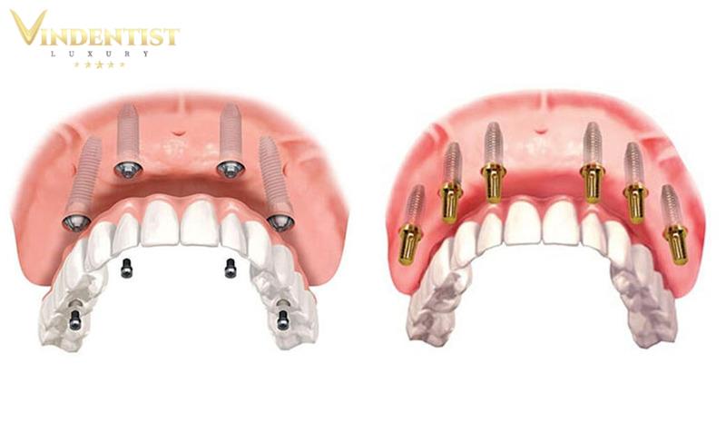 Giai đoạn 2 - 3 ngày sau khi cấy ghép implant