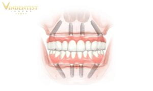 Giai đoạn 2 tuần sau khi trồng implant