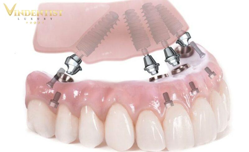 Giai đoạn sau khi trồng implant