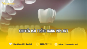 Khuyễn mãi khi trồng răng Implant