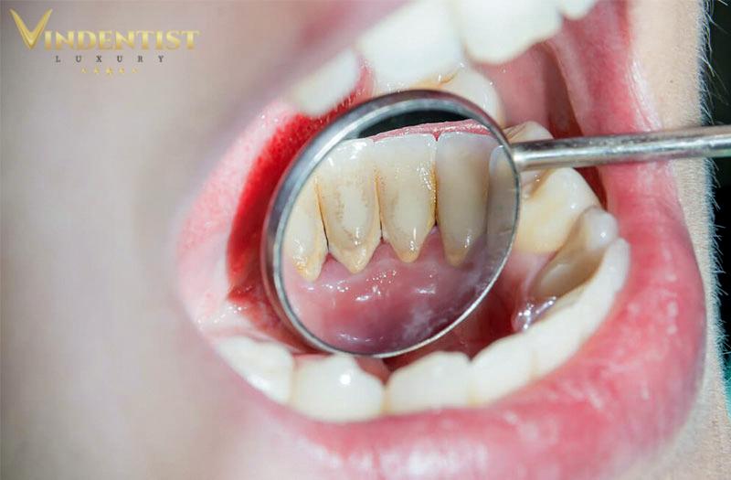 Kiểm tra kỹ bệnh lý răng miệng