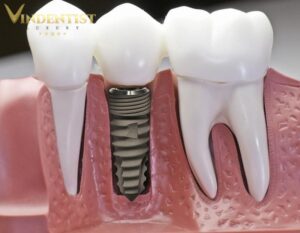 Lựa chọn trụ implant chất lượng
