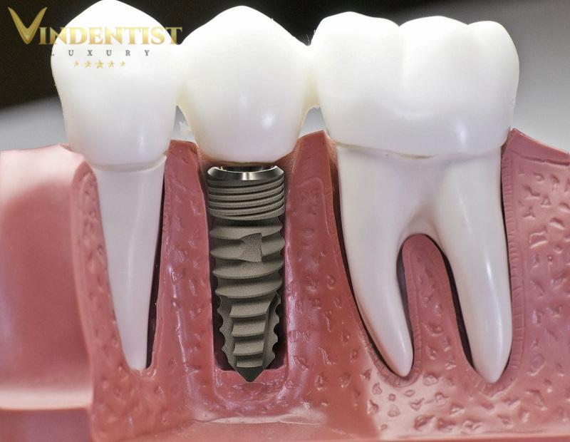  Lựa chọn trụ implant chất lượng