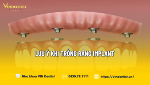 lưu ý khi trồng răng implant