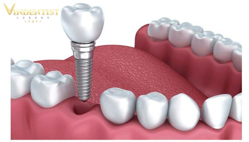 Những Lưu Ý Trước Và Sau Khi Trồng Răng Implant Phải Nắm