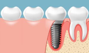 5 Địa Chỉ Trồng Răng Implant Ở Bình Dương Tốt Nhất