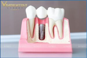 Đơn vị uy tín trồng răng Implant