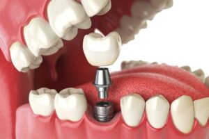 trồng răng hàm implant giá bao nhiêu