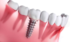 Ưu điểm của trồng răng implant