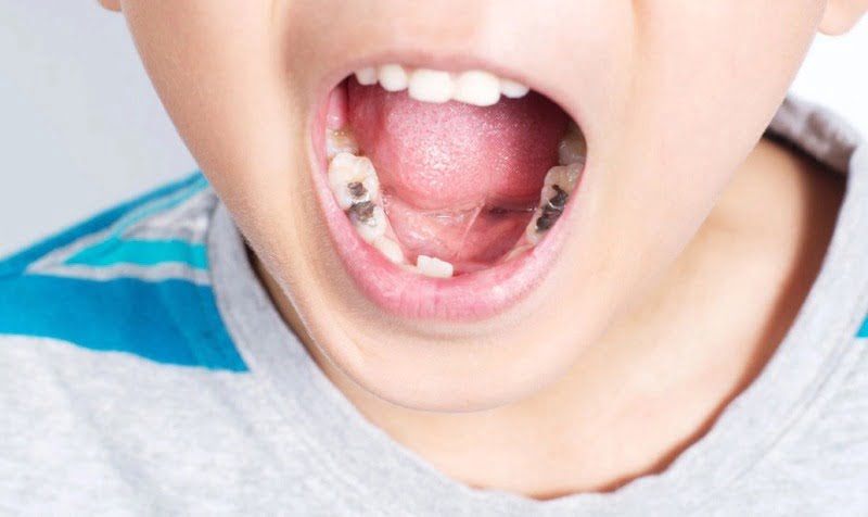 Trám Răng Sâu Bao Nhiêu Tiền? Có Bị Sâu Lại Không? 16 Các đối tượng thường bị sâu răng