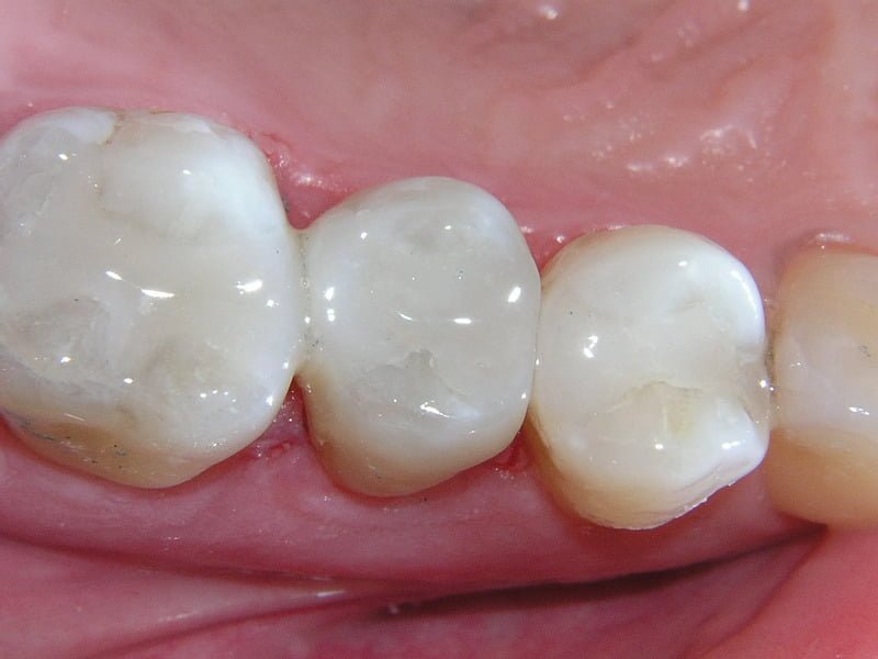 Trám Răng Sâu Bao Nhiêu Tiền? Có Bị Sâu Lại Không? 17 Các vật liệu trám răng sâu phổ biến