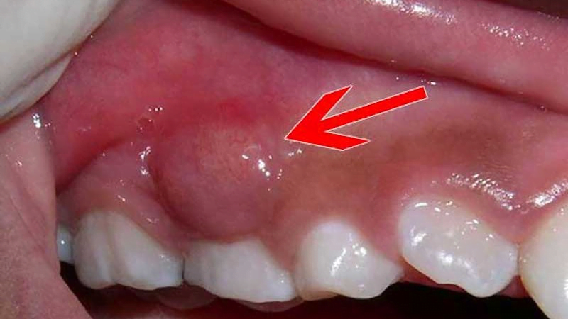 Viêm Nha Chu Là Gì? Cách Điều Trị Và Bảng Giá Chi tiết 17 Điều trị khẩn cấp