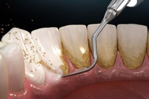 Điều trị không phẫu thuật