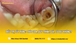 Điều Trị Tủy Răng: Thời gian, Quy trình, Giá, Có đau không?