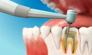 Điều trị tủy răng là gì?