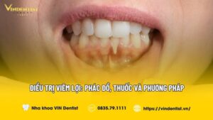 Điều Trị Viêm Lợi: Phác Đồ, Thuốc và Phương Pháp Hiệu Quả