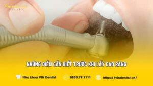 Những Điều Cần Biết Trước Khi Lấy Cao Răng | VIN Dentist