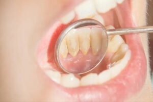 Lấy cao răng có tác hại gì không?