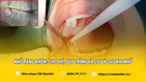 Nhổ Răng Khôn: Chi Phí, Quy trình và lưu ý sau khi nhổ