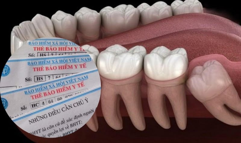 Nhổ Răng Khôn: Chi Phí, Quy trình và lưu ý sau khi nhổ 12 Nhổ răng khôn có được hưởng bảo hiểm y tế không?